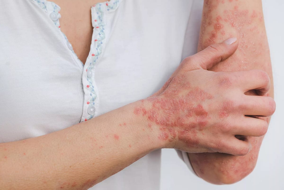 Magnétisme et eczéma chronique : récit de séance + résultats